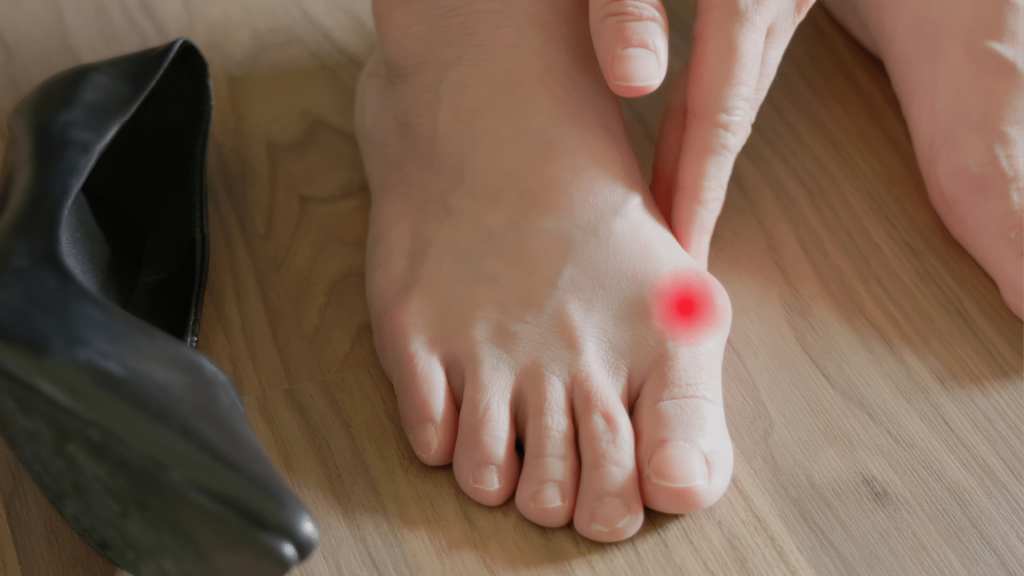 Hallux valgus - deformacija nožnih palcev